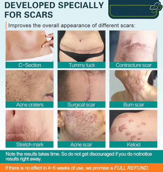 ScarRemove Advanced Scar Spray For All Types of Scars - For example Acne Scars. Surgical Scars and Stretch Marks ™