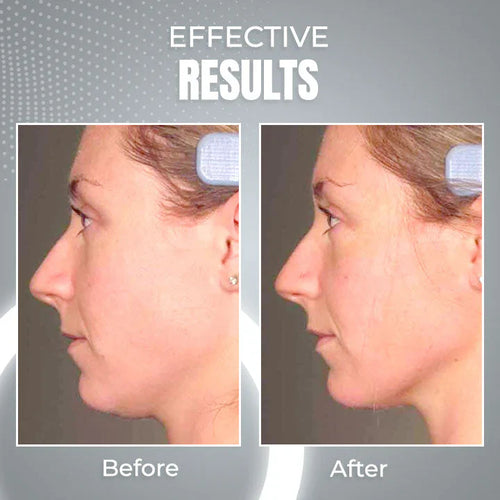 AntiChin - 2 in 1 Anti Snoring and Anti-Aging Facial Contouring Device 50 off™
