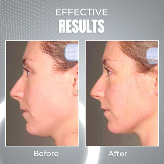 AntiChin - 2 in 1 Anti Snoring and Anti-Aging Facial Contouring Device 50 off™