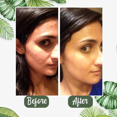 TeaGlow - Deep Cleanse Green Tea Mask™
