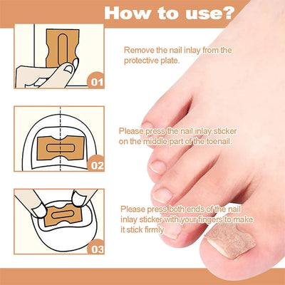 NailFixer™ - Toenail Paronychia Corrector (50 Pcs )