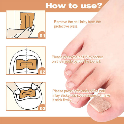 NailFixer™ - Toenail Paronychia Corrector (50 Pcs )