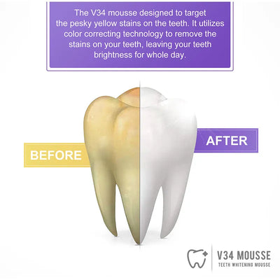 SmileBrite - Teeth Whitening Kit™