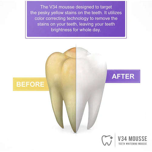 SmileBrite - Teeth Whitening Kit™