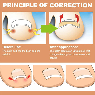 NailFixer™ - Toenail Paronychia Corrector (50 Pcs )