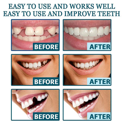 NewSmile - Snap-On Dentures™