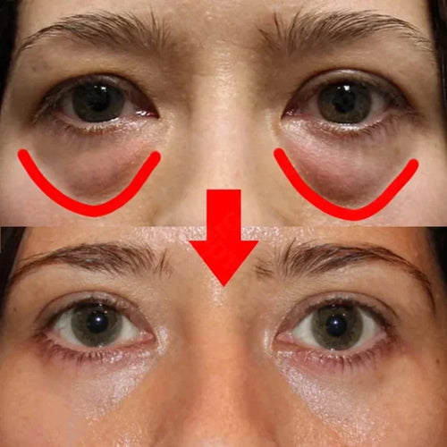 RadiantEyes - Eye Bags Removal Patch™