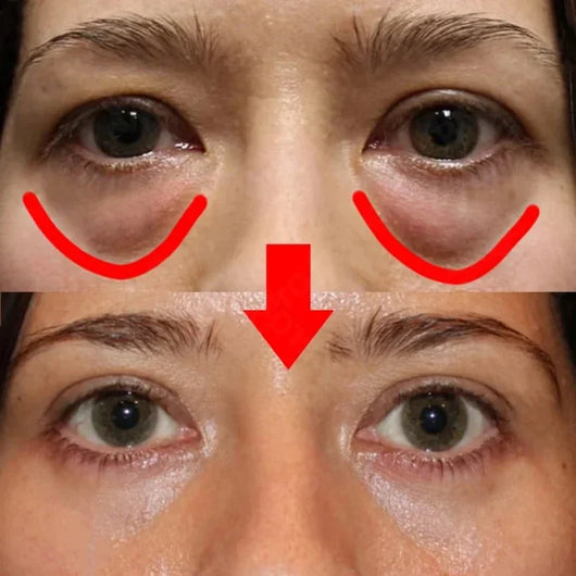 RadiantEyes - Eye Bags Removal Patch™
