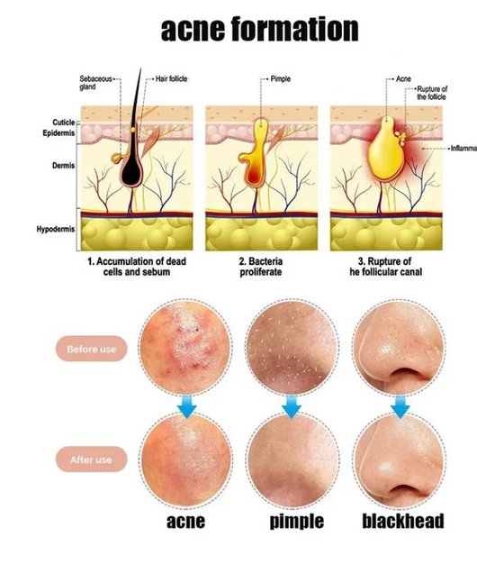 Ultra-Fine -Acne Blackhead Removal Kit™