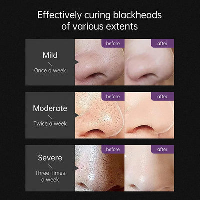 Cleanuest - Blackhead Remover Mask™