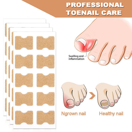 NailFixer™ - Toenail Paronychia Corrector (50 Pcs )