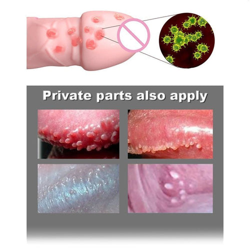 AntiWart - Painless Warts Solution™