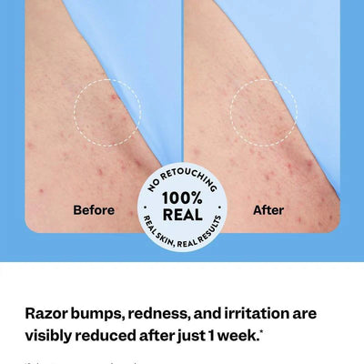 Relivra  - Ingrown Hair Treatment™