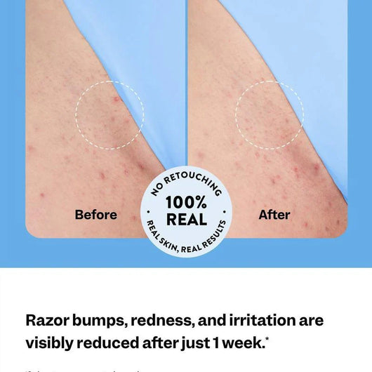 Relivra  - Ingrown Hair Treatment™