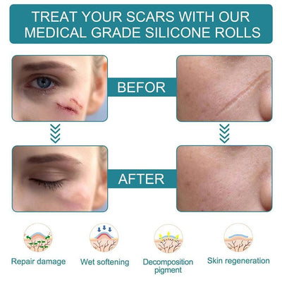 ELAIMEI™ Medical Soft Silicone Gel Tape for Scar Removal (1.6” x 60”） - TumTum
