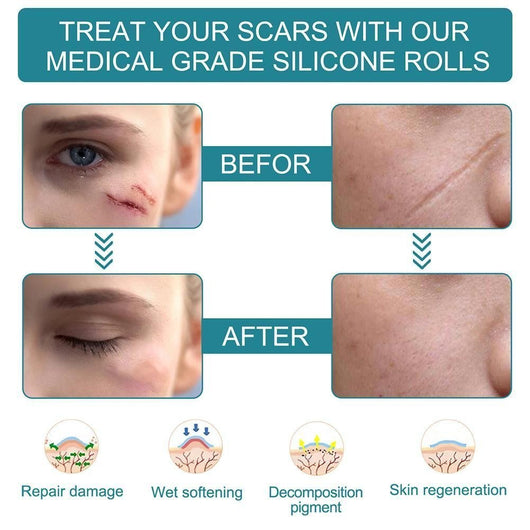 ELAIMEI™ Medical Soft Silicone Gel Tape for Scar Removal (1.6” x 60”） - TumTum