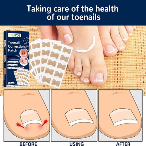 NailFixer - Toenail Paronychia Corrector 50 Pcs ™