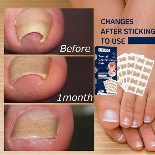 NailFixer - Toenail Paronychia Corrector 50 Pcs ™