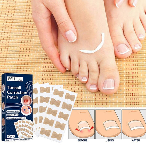 NailFixer - Toenail Paronychia Corrector 50 Pcs ™