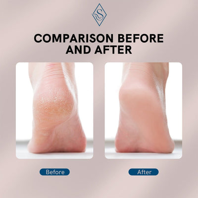Rechargeable Electric Foot Callus Remover Pedicure Machine - TumTum