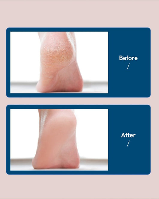 Rechargeable Electric Foot Callus Remover Pedicure Machine - TumTum