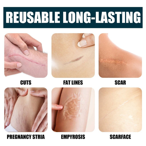 ScarAway100 Advanced Scar Gel, C-Section Scars, Tummy Tuck, Old Scars, Keloids, Stretch Marks, Burn Scars™