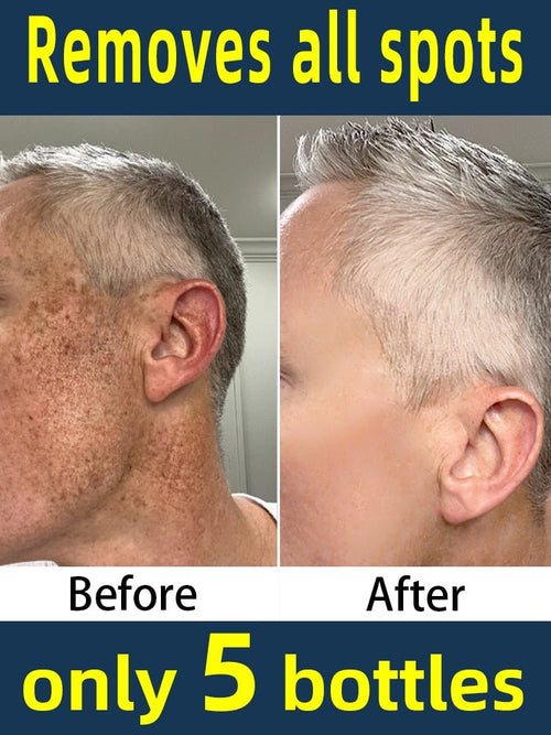 SpotBeGone Serum™