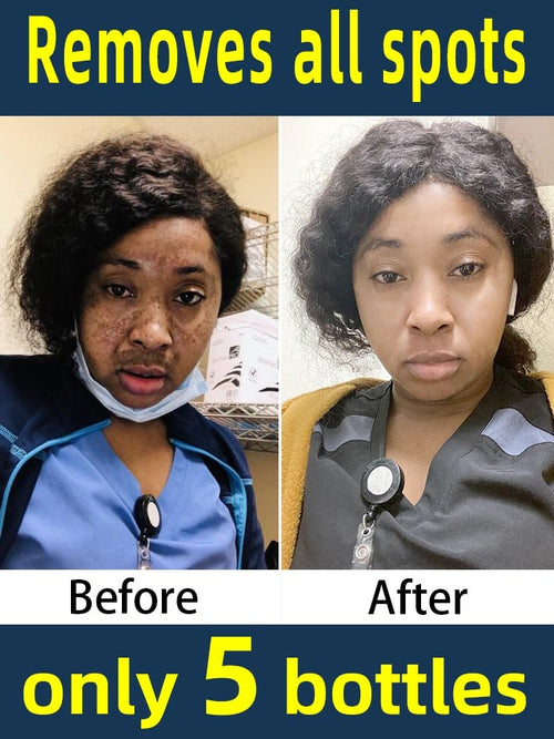 SpotBeGone Serum™